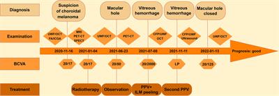 Macular hole and vitreous hemorrhage subsequent to stereotactic hypofractionated radiotherapy for choroidal melanoma: A case report and review of the literature